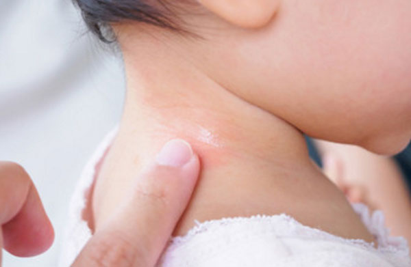 Нанесение лекарства на область с аллергической сыпью, возникшей при укусе насекомого