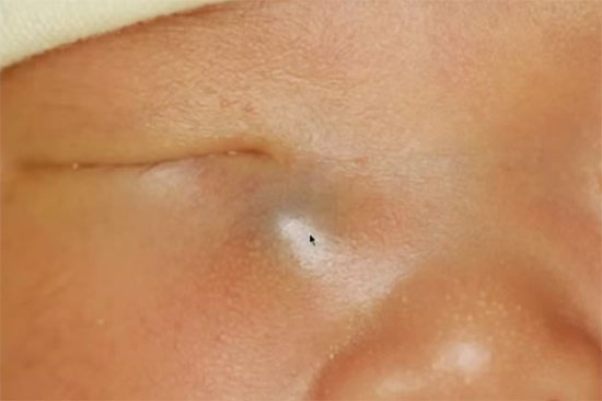 Дакриоцистит у новорожденного