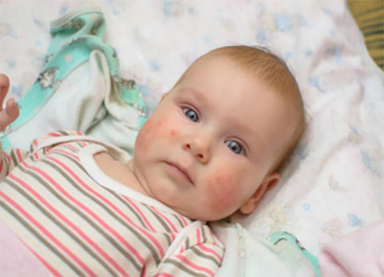 Грудной ребенок с сыпью на щеках