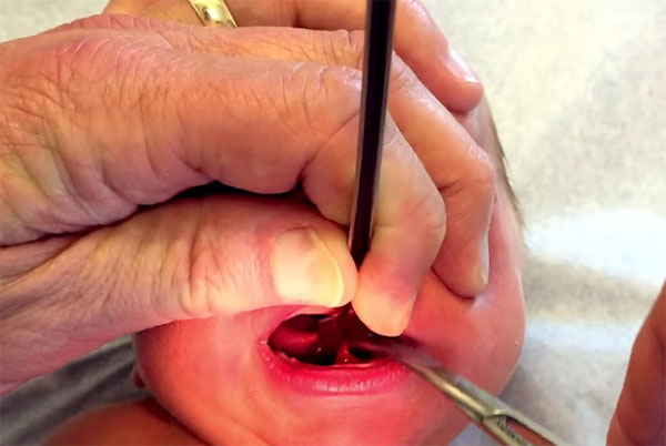 Операция по рассечению уздечки