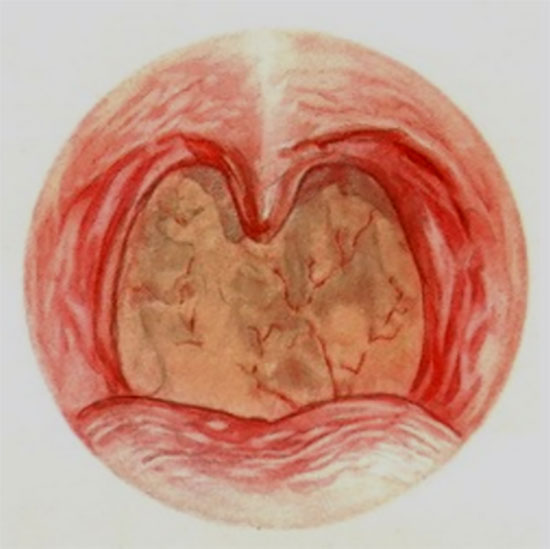 Картинка с изображением атрофической формы фарингита