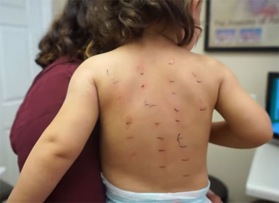 Аллергопробы на спине ребенка