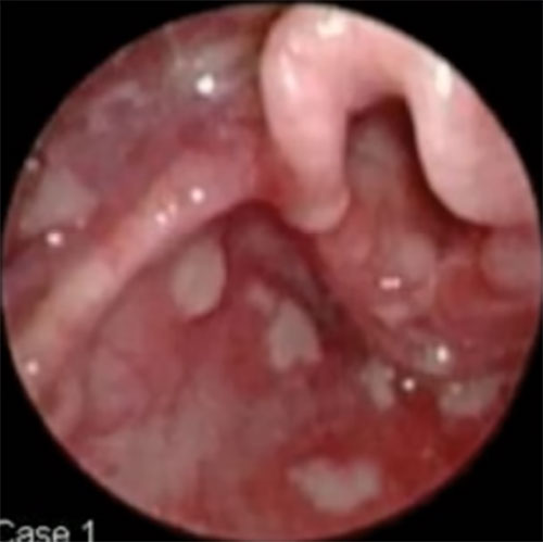 Снимок бактериального трахеита