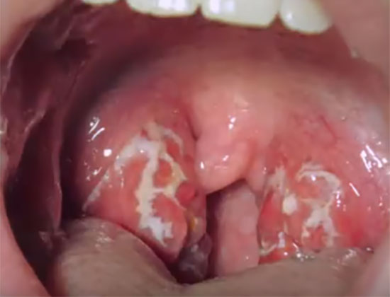 Горло со всеми проявлениями бактериального фарингита