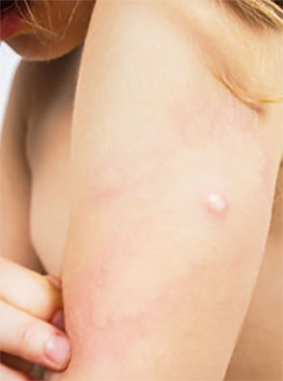 У девочки на руке след от укуса осы