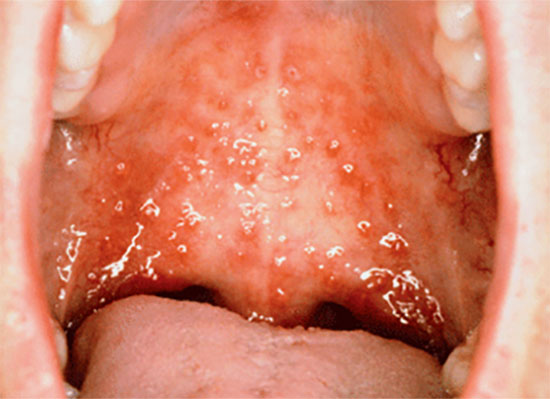 Герпетическая форма фарингита