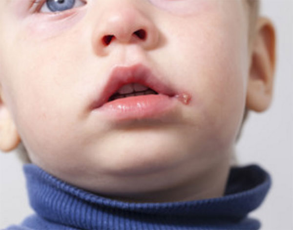 Герпетический стоматит у ребенка