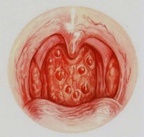 Картинка с изображением гранулезной формы фарингита