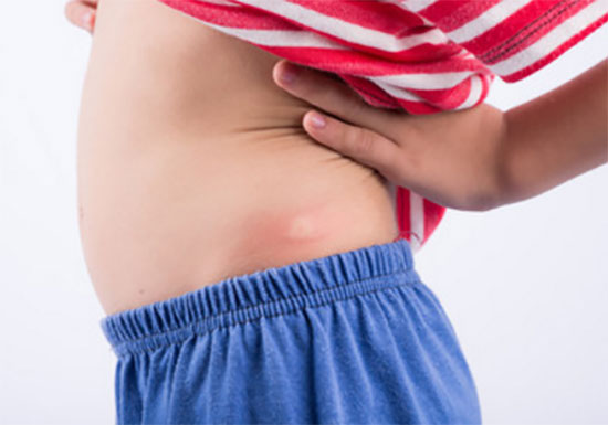 Ребенок с приподнятой футболкой. На теле след от укуса комара