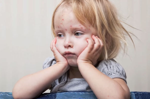 Ребенок болен корью