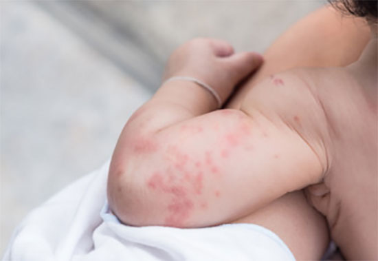 Рука ребенка с крапивницей