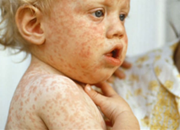 Малыш с краснухой