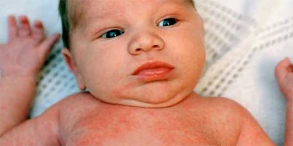 у ребенка краснуха