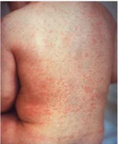 Ребенок с краснухой