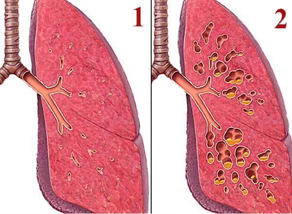 Изображение разреза двух легких: здорового и с муковисцидозом