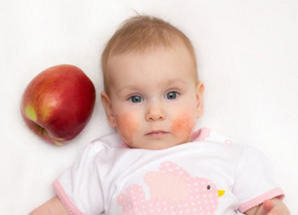 Ребенок с красными щеками, рядом лежит красное яблоко