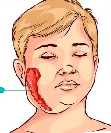 у ребенка свинка