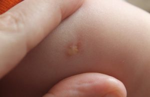 Прививка бцж на стадии заживания