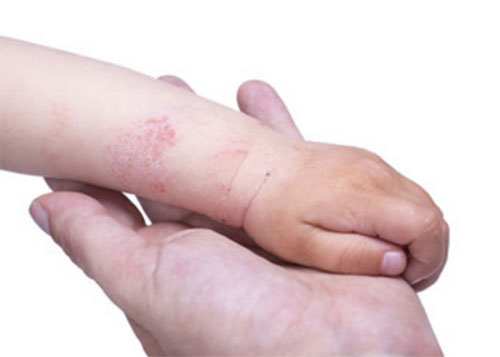 Ручка ребенка с характерными поражениями кожи в виде сыпи