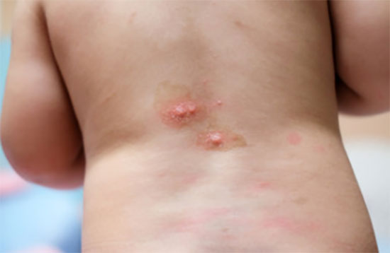 Спина ребенка с обработанными следами укусов