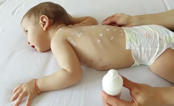 Малыш заболел ветрянкой