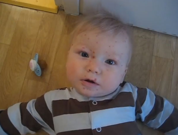 Малыш с ветрянкой