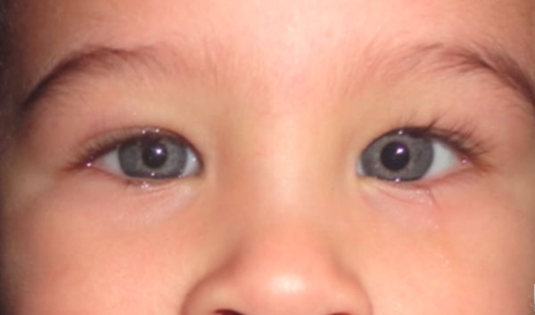 Разный размер зрачков