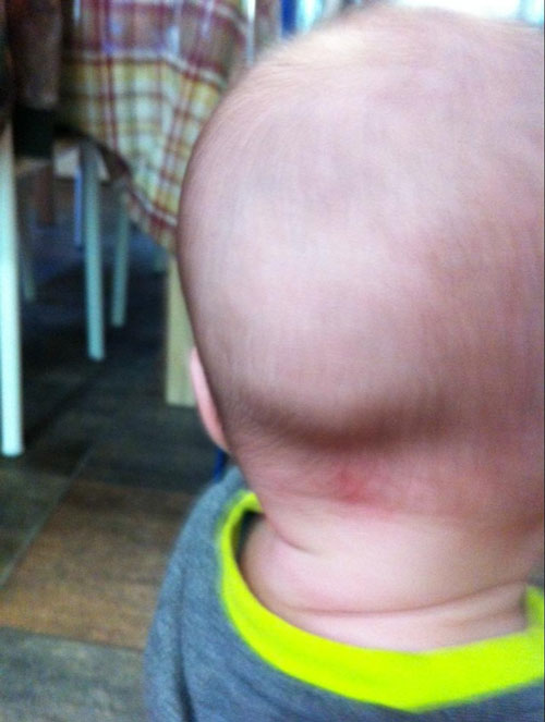 Удар затылком