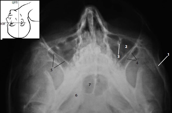 Рентгенограмма глазницы в аксиальной проекции по Schuller (1905) и Bowen (1914)