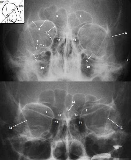 Рентгенограмма в передней полуаксиальной (подбородочной) проекции по Waters и Waldron