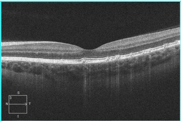 Доминантные друзы мембраны Бруха