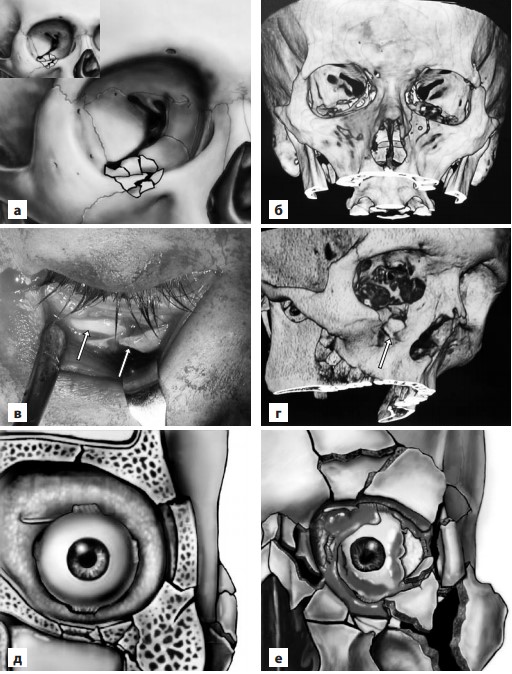 Средне- и высокоэнергетические переломы глазницы