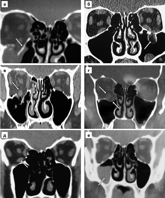 КТ- признаки перелома нижней стенки