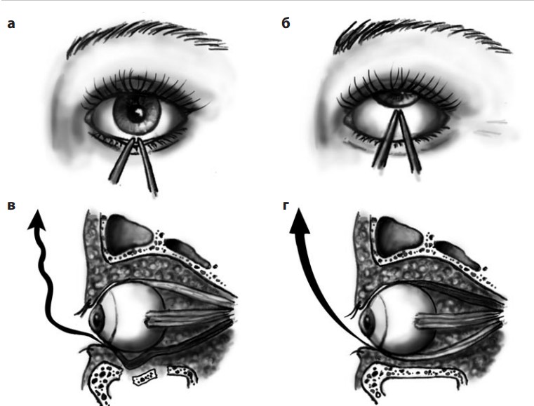 Методика тракционного теста