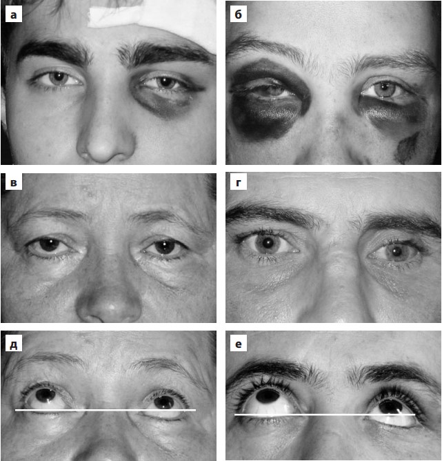 Клиническая картина перелома нижней стенки глазницы