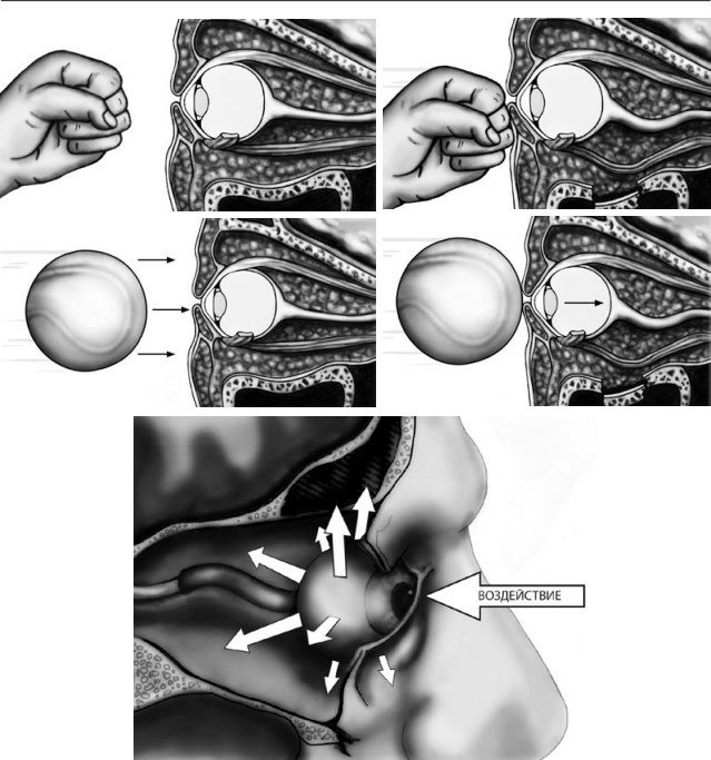 «Гидравлическая» теория возникновения перелома нижней стенки глазницы