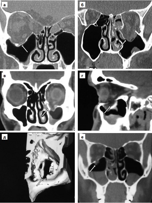 Показания к операции при переломах нижней стенки орбиты