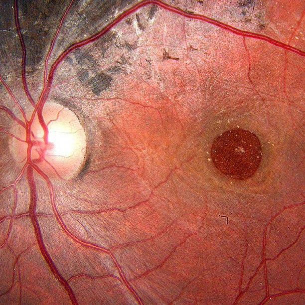 Травматический макулярный разрыв