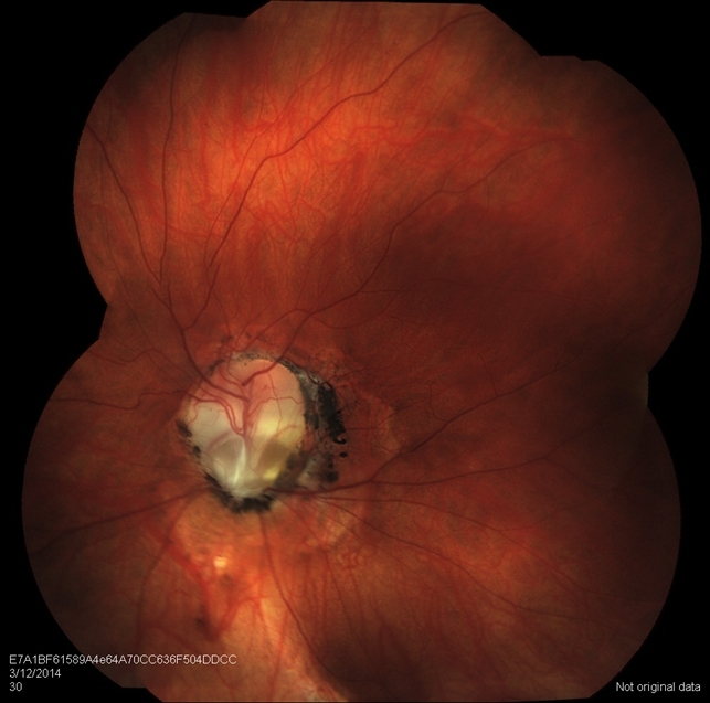 Колобома зрительного нерва