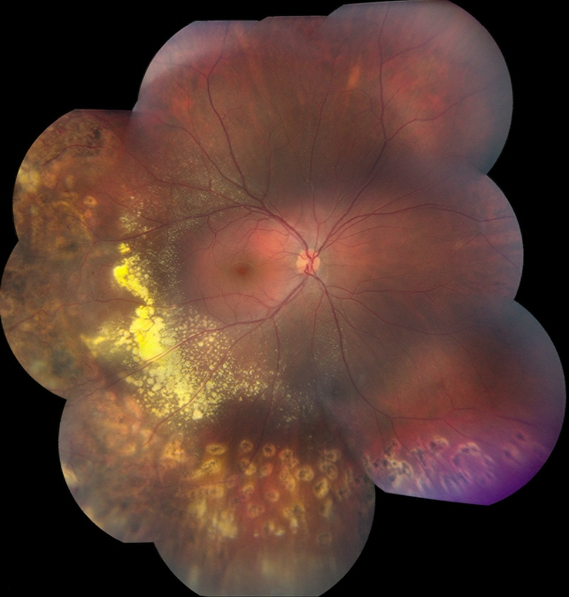 Болезнь Коатса