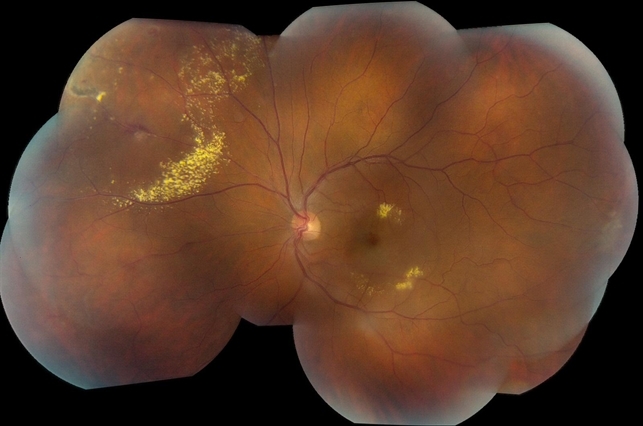 Болезнь Коатса