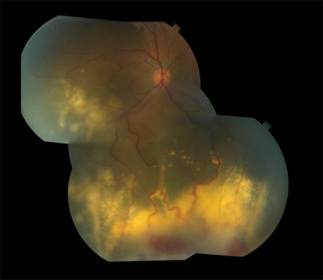 Болезнь Коатса