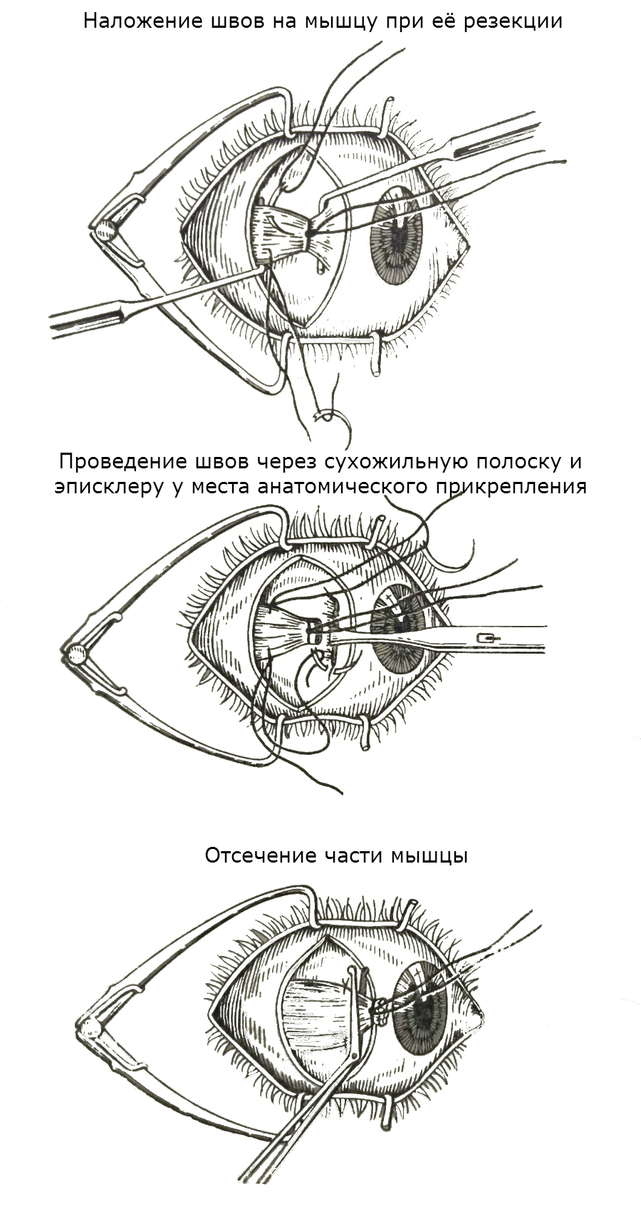 Шов по Фишеру
