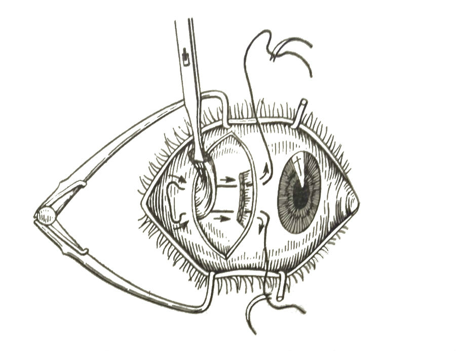 Наложение шва на резецируемую мышцу по методике Фишера