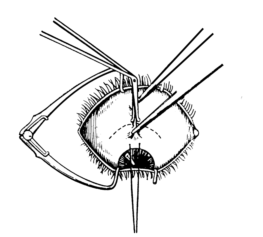 Разрез конъюнктивы и влагалища глазного яблока при операциях на верхней косой мышце