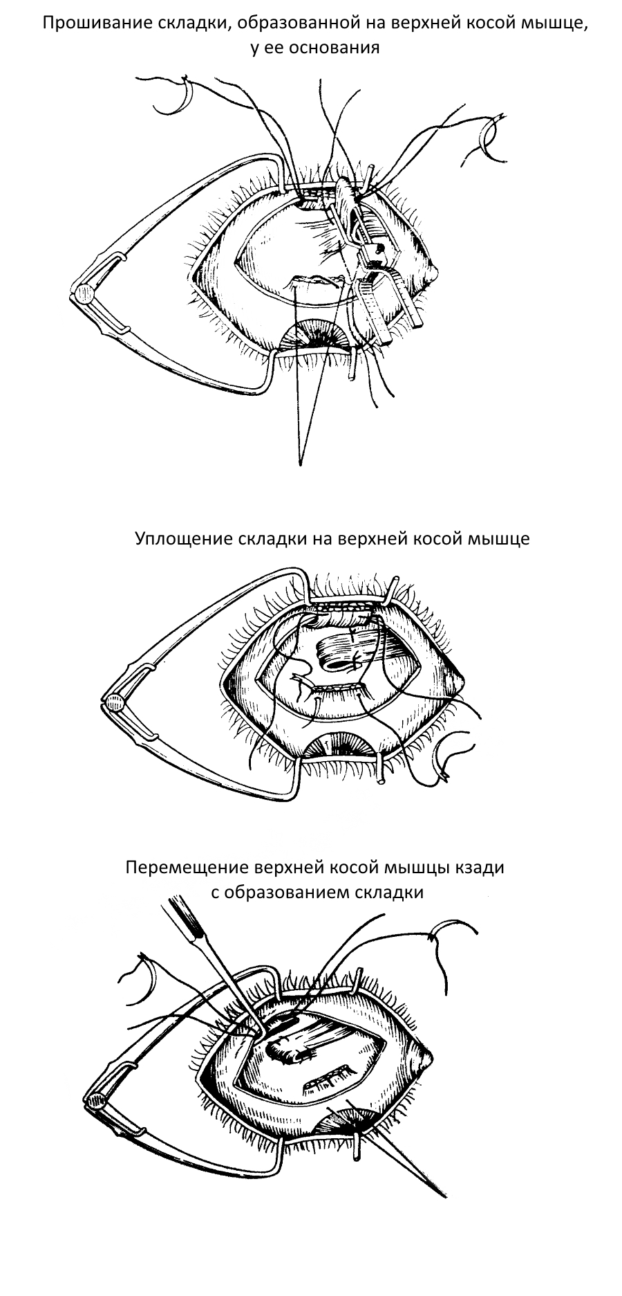 Операция образования складки на верхней косой мышце