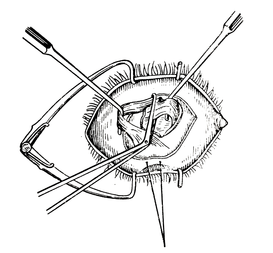 Тенотомия верхней косой мышцы