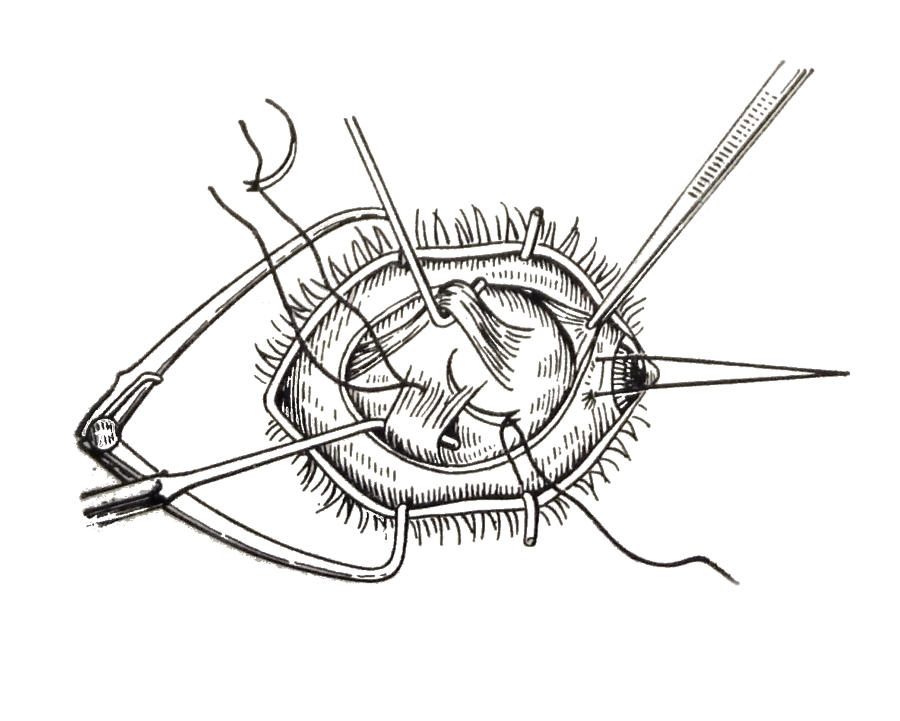 Выделение нижней косой мышцы