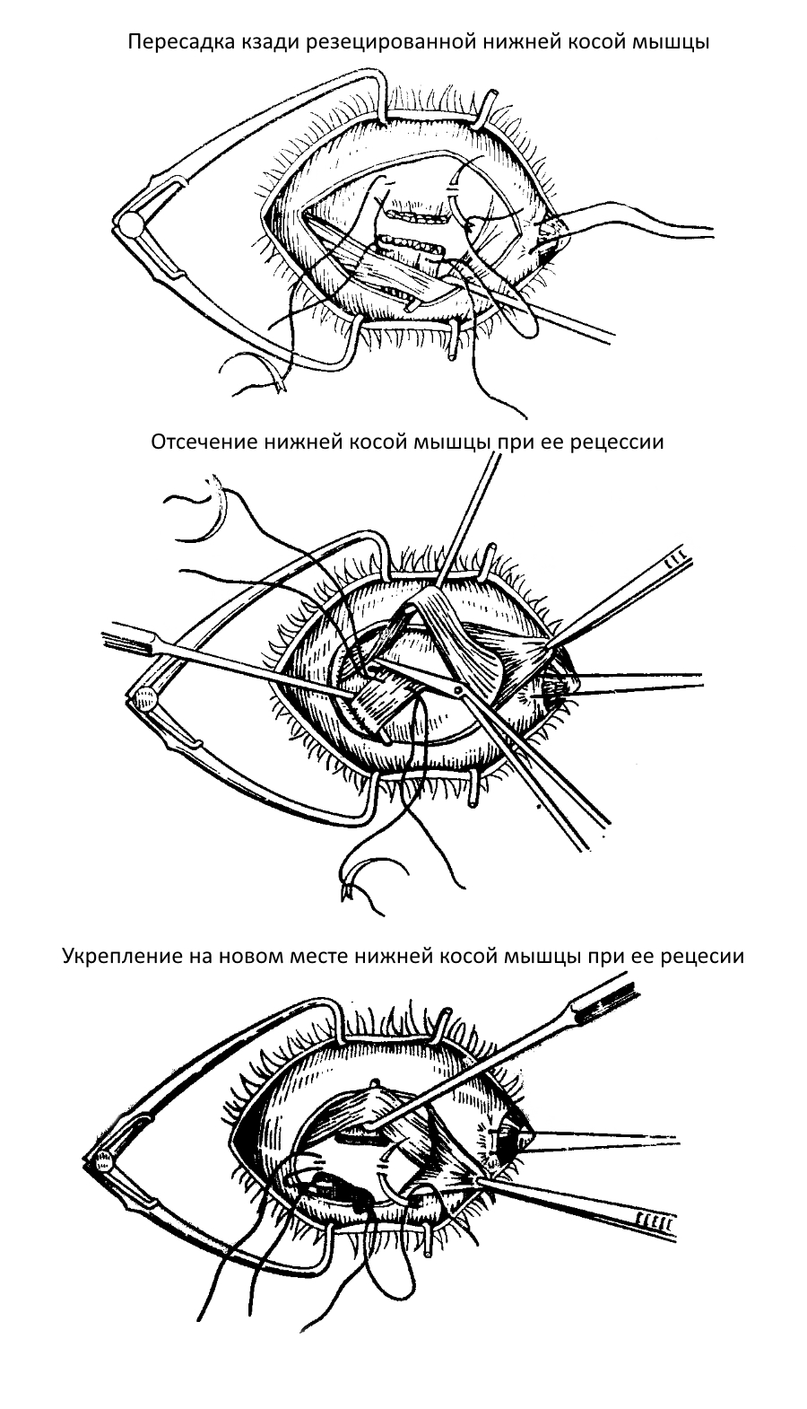 Этапы рецесии нижней косой мышцы