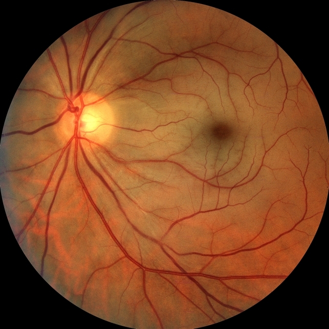 Симптом "вишневой косточки"